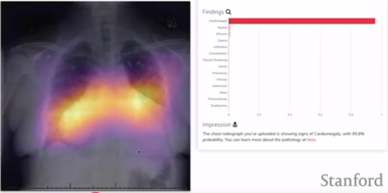 NN highlighting lung abnormalities